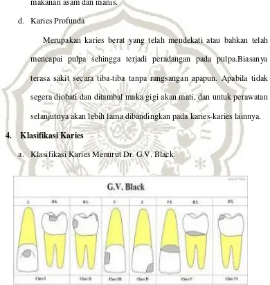Gambar 2.1 Klasifikasi karies gigi menurut G.V.Black 