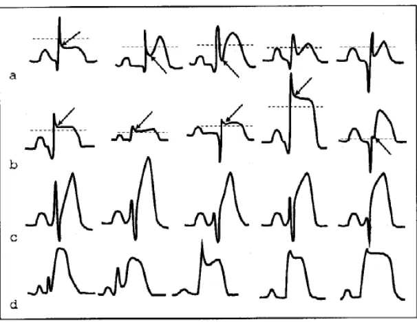 Gambar 2. EKG pasien STEMI tanpa distorsi QRS (a dan c) dan distorsi (b dan d) 