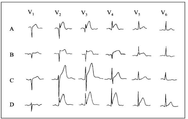 Gambar 3. STEMI anterior tanpa distorsi terminal QRS (A dan C) dan dengan distorsi (B dan D) 