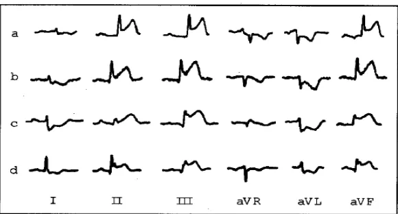 Gambar 4. STEMI inferior tanpa distorsi terminal QRS (A dan B) dan dengan distorsi 