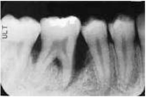 Gambar 6. Kehilangan tulang diakibatkan periodontitis ditinjau dari radiografi periapikal2  