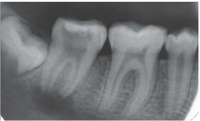 Gambar 9. Keadaan kamar pulpa gigi pada radiografi periapikal31 