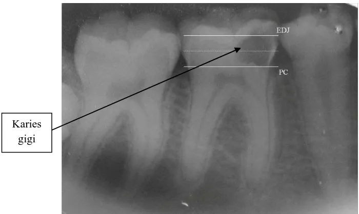 Gambar 10. Karies gigi ditinjau dari radiografi periapikal33 