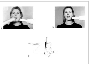 Gambar  2.  Teknik bisecting pada molar mandibula. Ibu jari sebagai        pemegang film; b