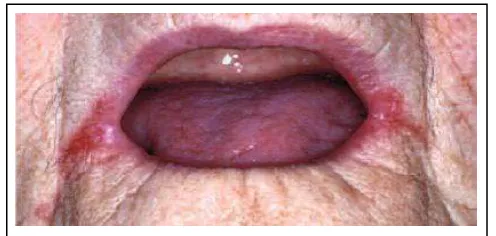 Gambar 1. Angular cheilitis pada pemakai gigi tiruan14 
