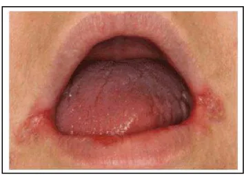 Gambar 2.  Angular cheilitis 19