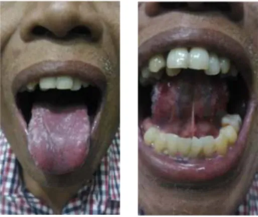 Gambar 1. Awal datang terdapat candida pada dorsal lidah dan inferior lidah           