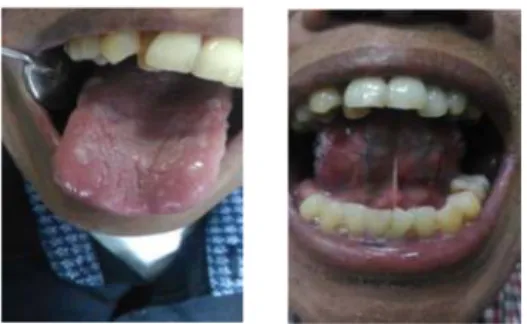 Gambar 2.  Sesudah konsumsi nystatin terdapat candida pada dorsal lidah dan inferior lidah 