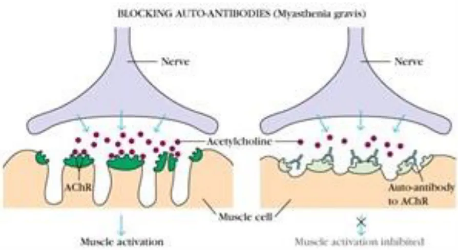 Gambar 1. Patogenesis Miastenia Gravis(8) 