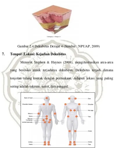 Gambar 2.4 Dekubitus Derajat 4 (Sumber : NPUAP, 2009) 