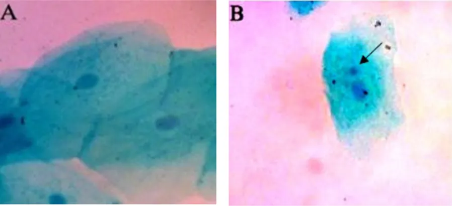Gambar  1  menunjukkan  gambaran  antara  inti  sel  normal,  mikronukleus,  dan  kondisi  inti  sel  yang  lain