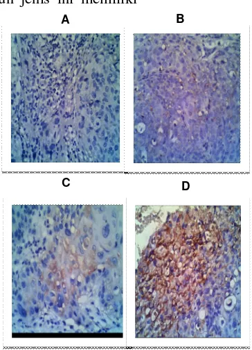 Gambar 2. Ekspresi COX-2 karsinoma sel skuamosa serviks berkeratin (400X). A.negatif; B