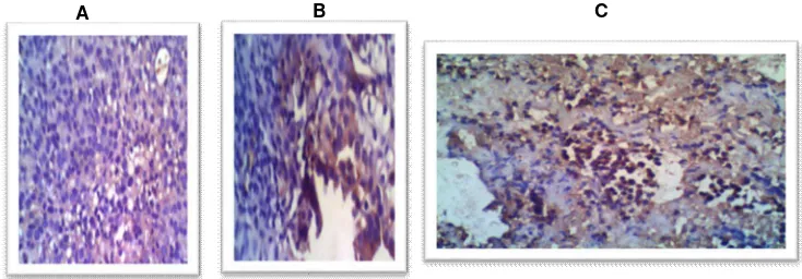 Gambar 4. Ekspresi COX-2 karsinoma sel skuamosa serviks  tidak berkeratin tipe sel kecil (400X)