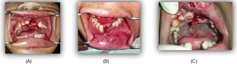 Gambar 2. Gambaran Intra oral: (A). Tampak laserasi pada regio bibir atas, gingiva regio gigi 21 – 22, dan oklusi tidak didapat karena rahang atas dan bawah terdapat fraktur