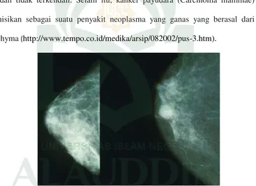 Gambar 2.7 Mammogram yang menunjukkan payudara normal (kiri) dan payudara dengan kanker (kanan) (Sumber: https://id.wikipedia.org/wiki/kanker_payudara) 