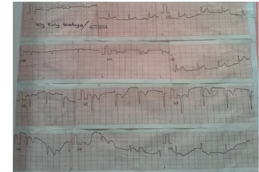 Gambar 1.  Gambaran Elektrokardiogram ketika Pasien Datang di Instalasi Rawat  Darurat.