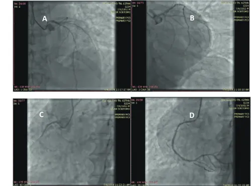 Gambar 2.  Angiografi Arteri Koroner. (A) LMCA normal, LAD tampak diffuse disease  dari mid-distal dengan maksimal stenosis 95% di mid LAD; (B) LCx non-dominan dan  normal; (C)RCA dominan dan tampak total oklusi di proksimal RCA; (D) RCA setelah  dilakukan