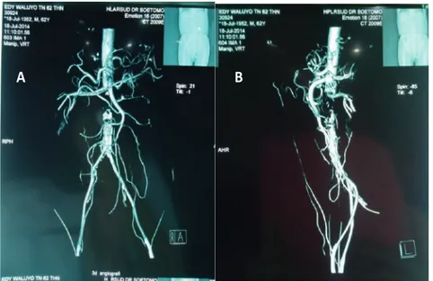 Gambar 3. CT Angiografi dengan Kontras pada Aorta Abdominalis dengan Proyeksi  Antero-Posterior(A) dan lateral (B)