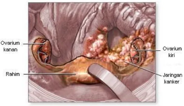 Gambar 3. Jaringan Kanker pada Ovarium Kiri (Anonim, 2010h) 
