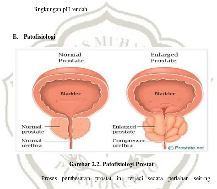 Gambar 2.2. Patofisiologi Prostat 