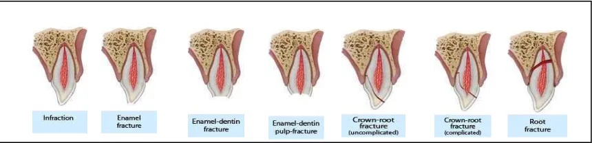 Gambar 1. Kerusakan pada Jaringan Keras Gigi danPulpa1,2 