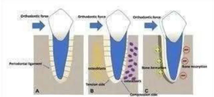 Gambar 2.2 Mekanisme pergerakan gigi pada perawatan ortodonti  ( Sumber : Ika Ketut I.S