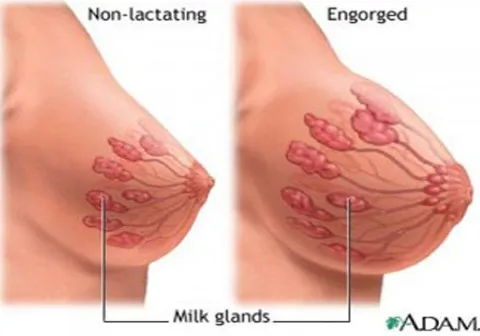 Gambar 2.2 Pembengkakan payudara  