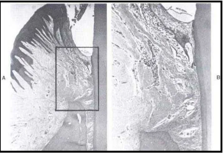 Gambar 4. Gambaran histopatologis adanya inflamasi gingiva yang menjalar ke tulang alveolar.5 