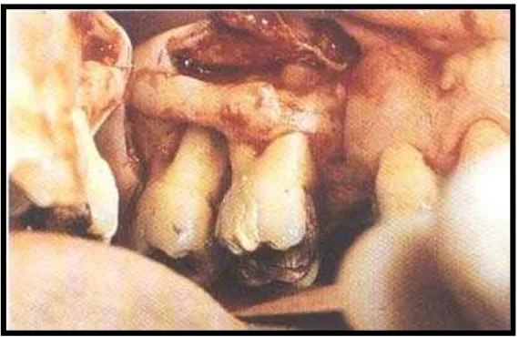 Gambar 7. Perbandingan antara tulang alveolar normal dan krater tulang.5,10 