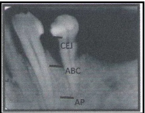 Gambar 11. Pengukuran untuk menentukan level kehilangan tulang alveolar (CEJ = batas sementum enamel, ABC = puncak tulang alveolar dan AP = apex akar).3  