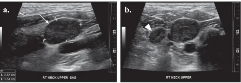 Gambar 10. Gambaran dari nodus metastases, a) potongan longitudinal dan b) potongan transversal dari USG