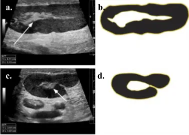 Gambar 18. Gambaran ketidakhadiran hilum echogenik, a) Potongan longitudinal dan transversal dari USG pada lymphnodes; b) Contrast -enhanced axial CT image; c) Diagram dari proses patologis yang progresif