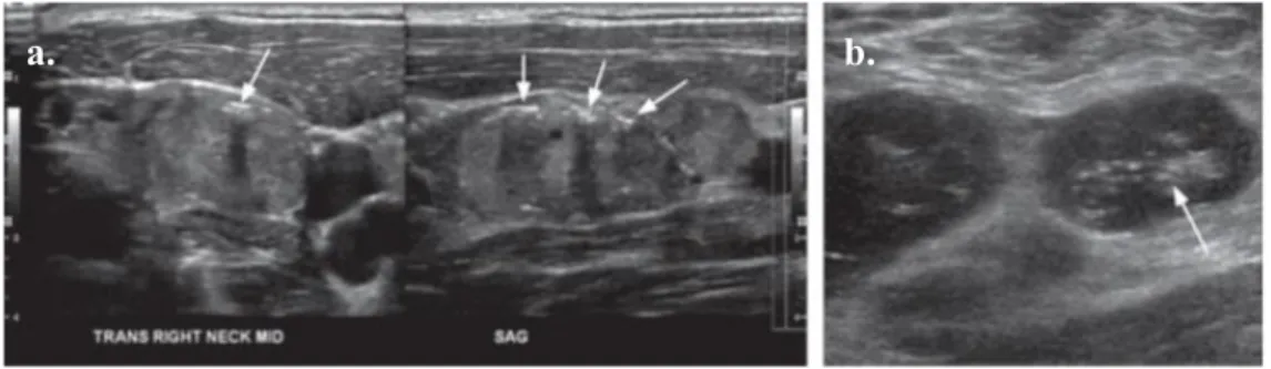 Gambar 19. Gambaran kalsifikasi pada lesi metastases pada USG, a) Potongan transversal dan longitudinal dari USG  pasien thyroid carcinoma, terlihat adanya kalsifikasi (panah), limfadenopati; b) Potongan transversal dari USG pasien 