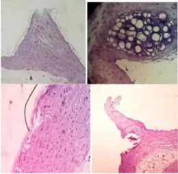 Gambar  2.  Arteri  koronaria  tikus putih jantan  galur  wistar  yang diberi  diet  aterogenik  selama  8 minggu perbesaran 40x