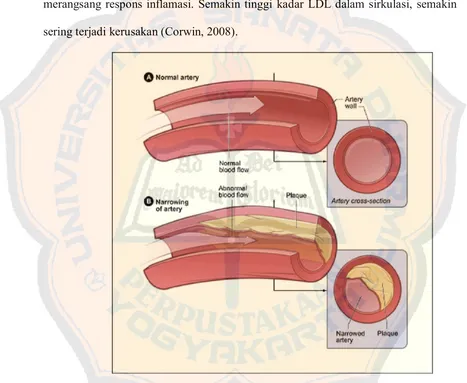 Gambar 5. Arteri normal dengan aliran darah normal (atas). Arteri dengan adanya 