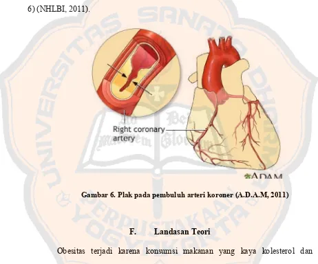 Gambar 6. Plak pada pembuluh arteri koroner (A.D.A.M, 2011) 