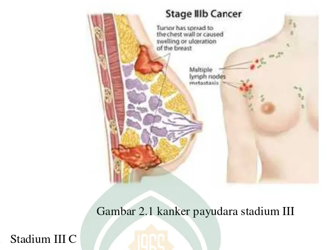Gambar 2.1 kanker payudara stadium III