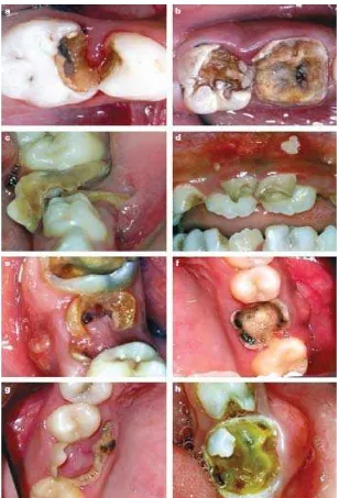 Gambar 2. (a dan b) keterlibatan pulpa (p); (c dan d) ulserasi (u);  (e dan f) fistula (f); (g dan h) abses dento-alveolar (a).11 