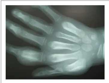 Figure 7. Secondary yaws: radiographic evidence of osteoper- osteoper-iostitis. Copyright Oriol Mitja`.