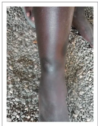 Figure 8. Primary yaws: healed Lesion. Copyright Michael Marks.