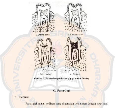 Gambar 3. Perkembangan karies gigi (Anonim, 2010a) 