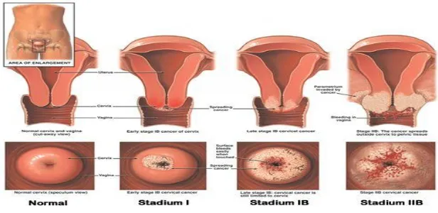 Gambar  2. 4. Ilustrasi kondisi vagina pada beberapa tahap stadium kenker 