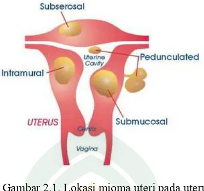 Gambar 2.1. Lokasi mioma uteri pada uterus