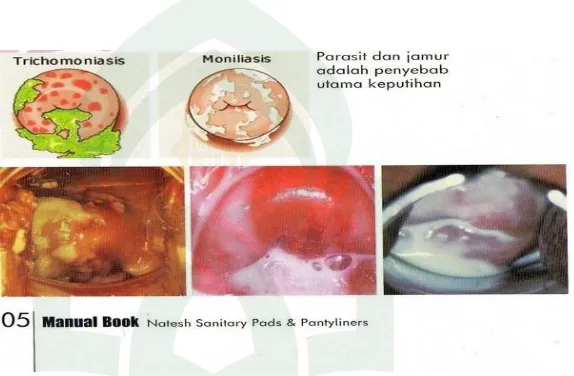 Gambar 2. Penyebab Keputihan Patologis Sumber : (http://medicastore.com) 