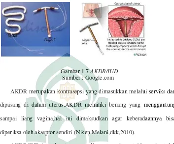 Gambar 1.7 AKDR/IUD 