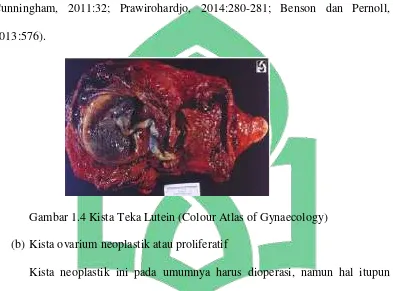 Gambar 1.4 Kista Teka Lutein (Colour Atlas of Gynaecology) 