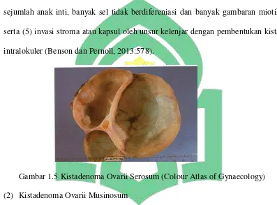 Gambar 1.5 Kistadenoma Ovarii Serosum (Colour Atlas of Gynaecology) 