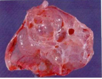 Gambar 1.6 Kistadenoma Ovarii Musinosum (Colour Atlas of Gynaecology) 