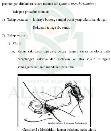 Gambar 2 : Melahirkan lengan belakang pada tehnik  melahirkan bahu cara klasik. Sumber : Eniyati, 2013.h:101 