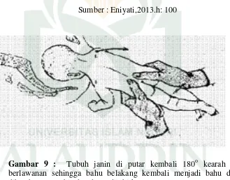 Gambar 8 :  Tubuh janin diputar kembali 180o kearah yang berlawanan sehingga bahu belakang kembali menjadi bahu depan dibawah arcus pubis dan dapat dilahirkan